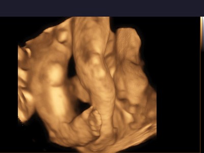 pregnancy, 32 weeks of pregnancy, clubfoot, clubfeet, diagnosis, ultrasound scan