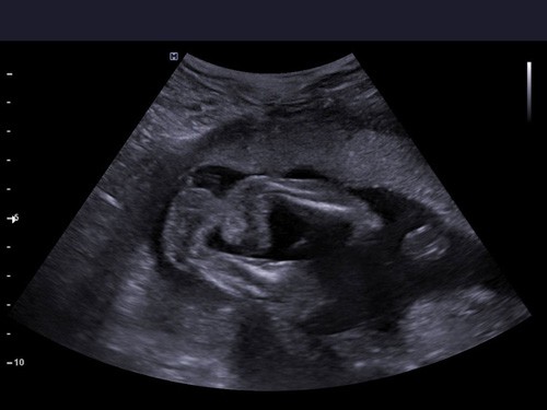 pregnancy, 22 weeks of pregnancy, clubfoot, clubfeet, diagnosis, ultrasound scan