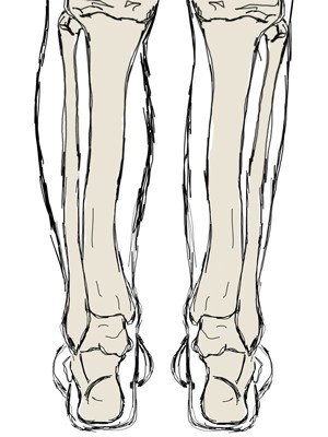 clubfoot, clubfeet, curve foot, pes equinovarus, calf, calf muscles,thin calf