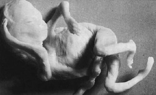 płód, fetus, Ponseti, Ignacy Ponseti, Ignacio Ponseti, POnseti method, metoda Ponsetiego, anatomia, badania, biomechanika, krzywa stopa, stopa konsko-szpotawa, stopa końsko-szpotawa, stopy konsko-szpotawe, stopy końsko-szpotawe, clubfoot, clubfeet