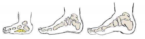 development of child foot, fat pad in foot