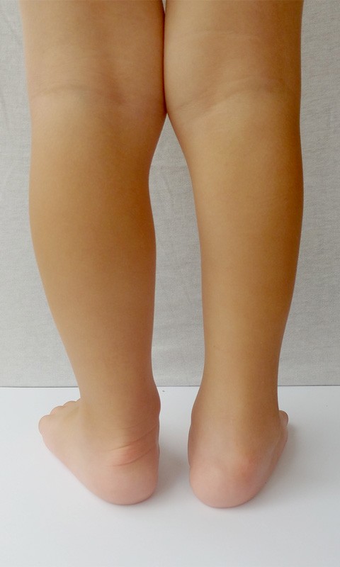 calf, calf muscles in clubfoot, calf muscles in normal foot, comparison