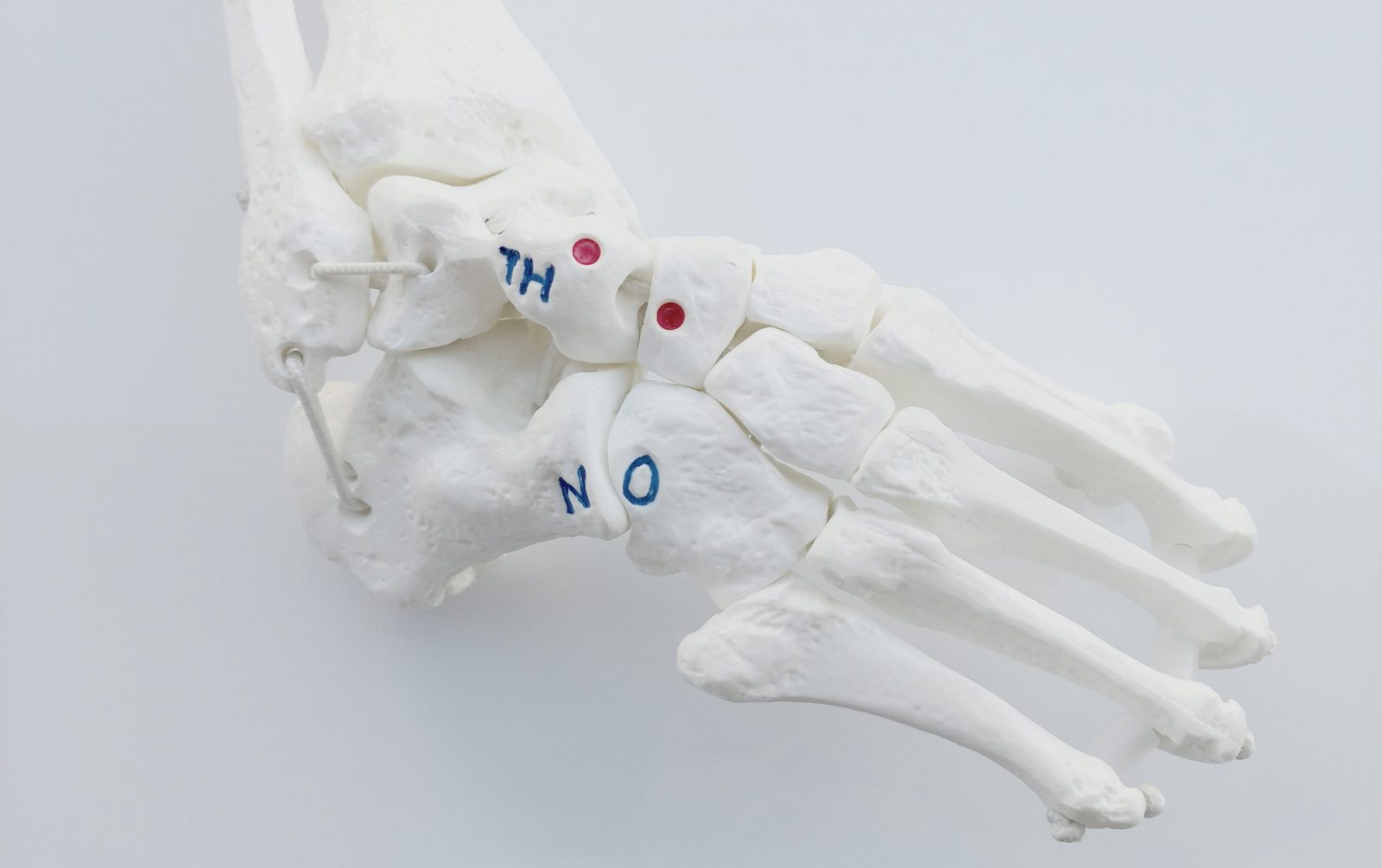 krzywa stopa, stopa konsko-szpotawa, stopa końsko-szpotawa, stopy konsko-szpotawe, stopy końsko-szpotawe, clubfoot, clubfeet, szkielet stopy