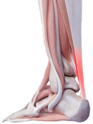 Achilles tendon, structure of foot, skeleton of foot, tendons, ligaments, soft tissues, elastic