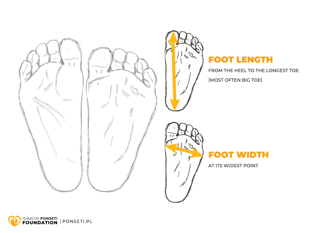 How to measure the clubfoot properly? - Fundacja Ponsetiego