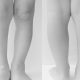 łydka, mięśnie łydki, różnice, zdrowa noga, noga z wadą, calf, calf muscles in clubfoot, calf muscles in normal foot, comparison, porównanie, stopa konsko-szpotawa, stopa końsko-szpotawa, stopy konsko-szpotawe, stopy końsko-szpotawe, clubfoot, clubfeet