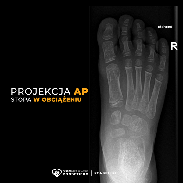 stopa, RTG, projekcja AP, anterior posterior, zdjęcie RTG, stopa końsko-szpotawa